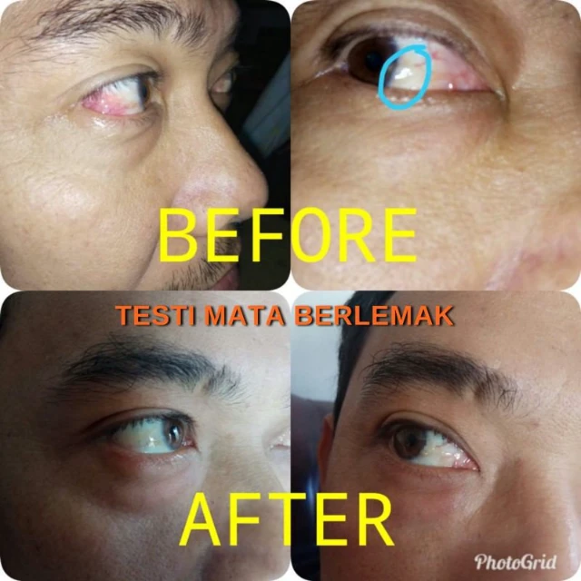 1743039537714-mata berlemak
