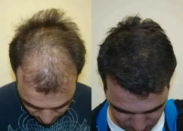 1764045099235-Hair-transplant-cost-is-costly-but-if-anyone…-1_1_7-1-1