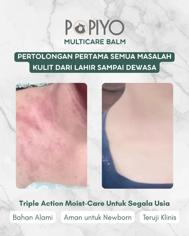 1778647158071-Kulit Bayi Kering & Sering Kemerahan (3)