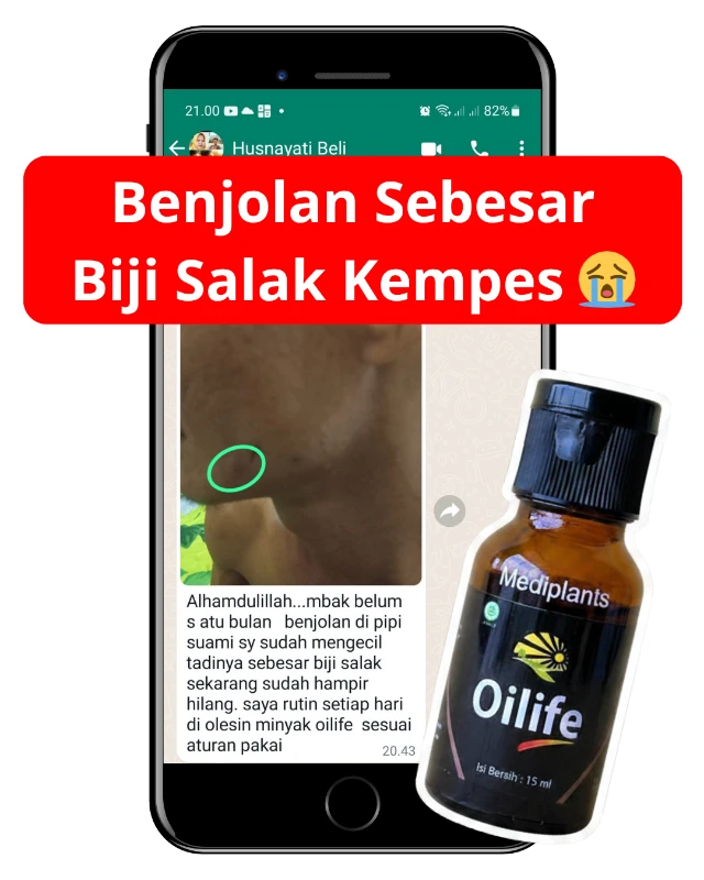 Testimoni pengguna OILIFE — herbal benjolan di leher